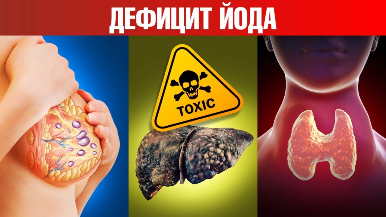 Здоровая щитовидная железа vs увеличенная от недостатка йода, наглядное сравнение