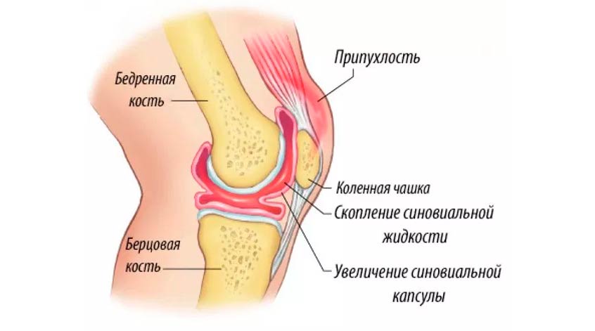 Анатомическая схема сустава с выделенной синовиальной жидкостью